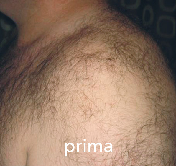 Stardust Med – prije tretmana (primjer 2)