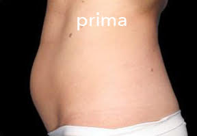 Yeti – prije tretmana (primjer 1)
