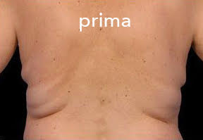 Yeti – prije tretmana (primjer 2)